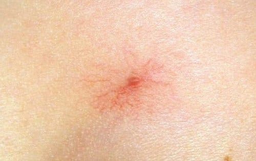 Araña vascular