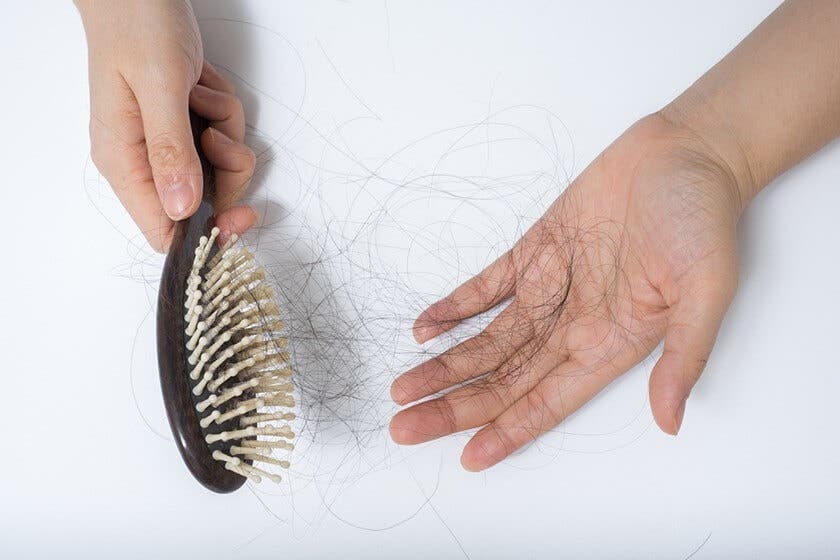 Caída cabello por sífilis