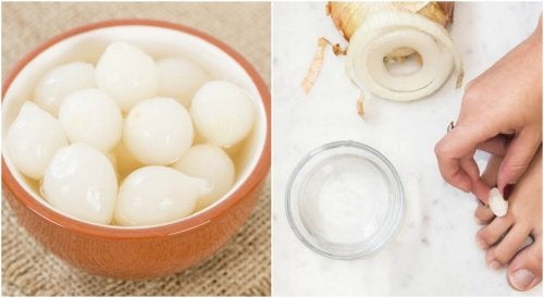 ¿Tienes callos en los pies? Combátelos con esta solución 100 % natural