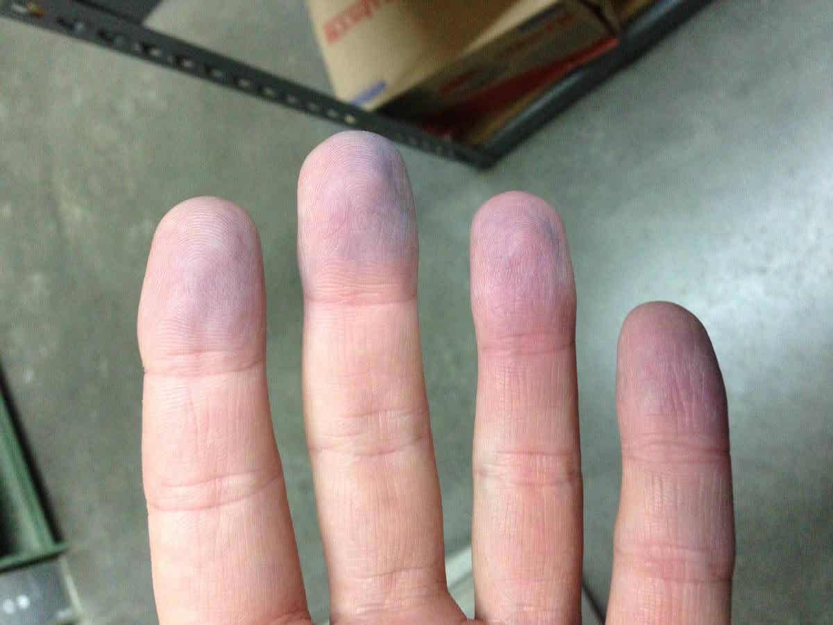 Dedos con cianosis