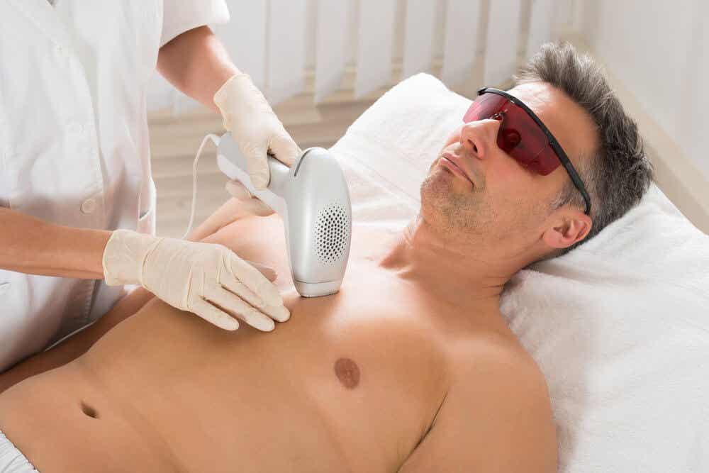 depilacja laserowa u mężczyzny