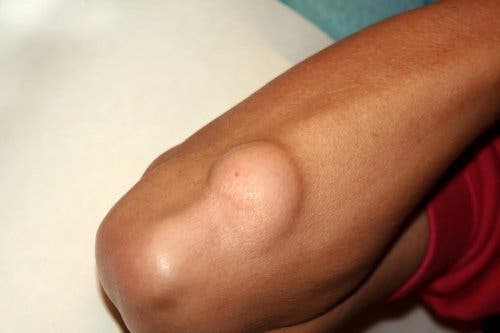 Hombre con lipoma brazo