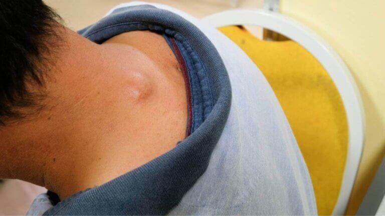 ¿Qué es un liposarcoma?