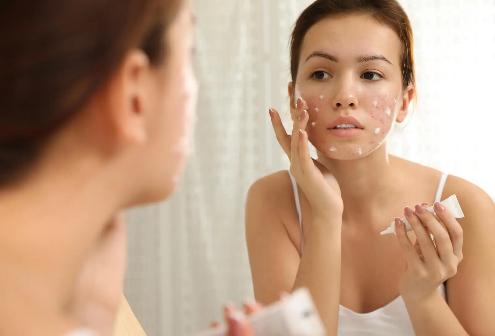 Adolescente com acne.