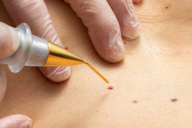 El angioma en adultos