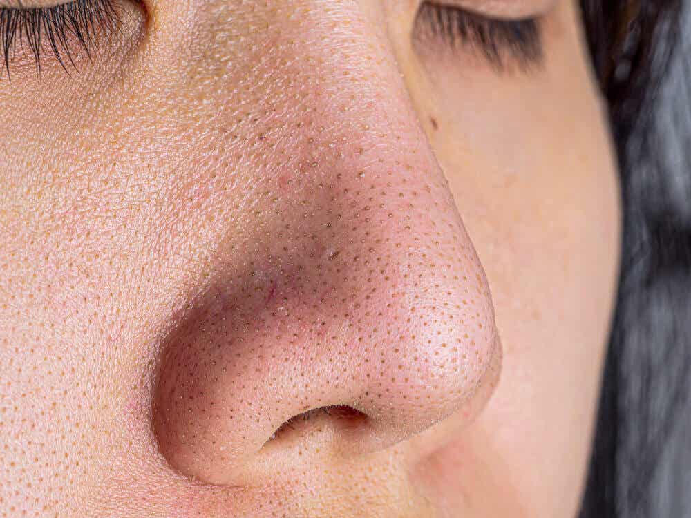 Closed Comedones are the opposite of blackheads