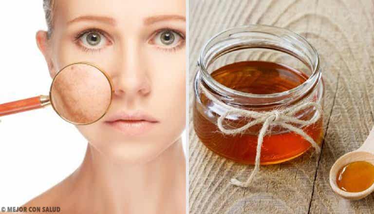 5 remedios caseros para tratar las infecciones en la piel