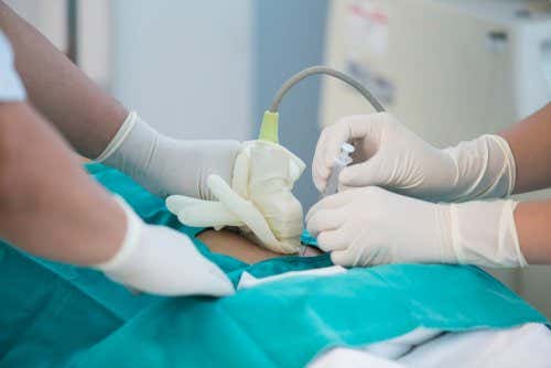 Técnica invasiva a través de la cual se obtiene sangre del cordón umbilical del feto.