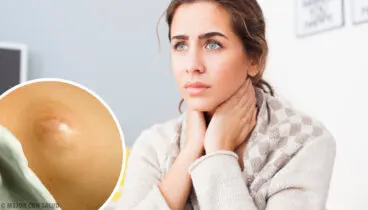 Lipoma: todo lo que debes saber