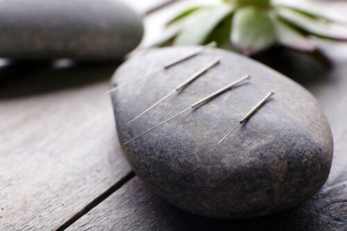 Acupuntura: ¿cuáles son sus aportes a la salud?