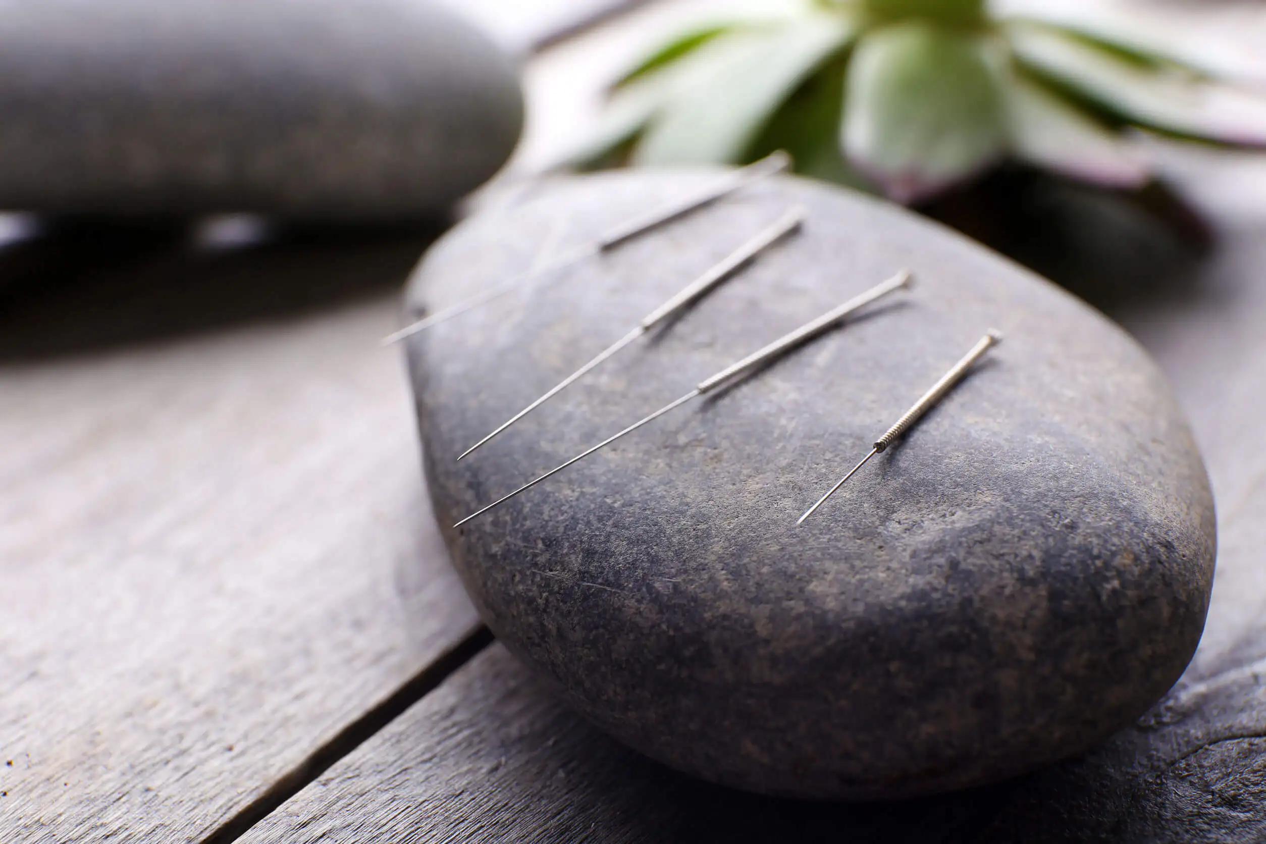 Acupuntura: ¿cuáles son sus aportes a la salud?