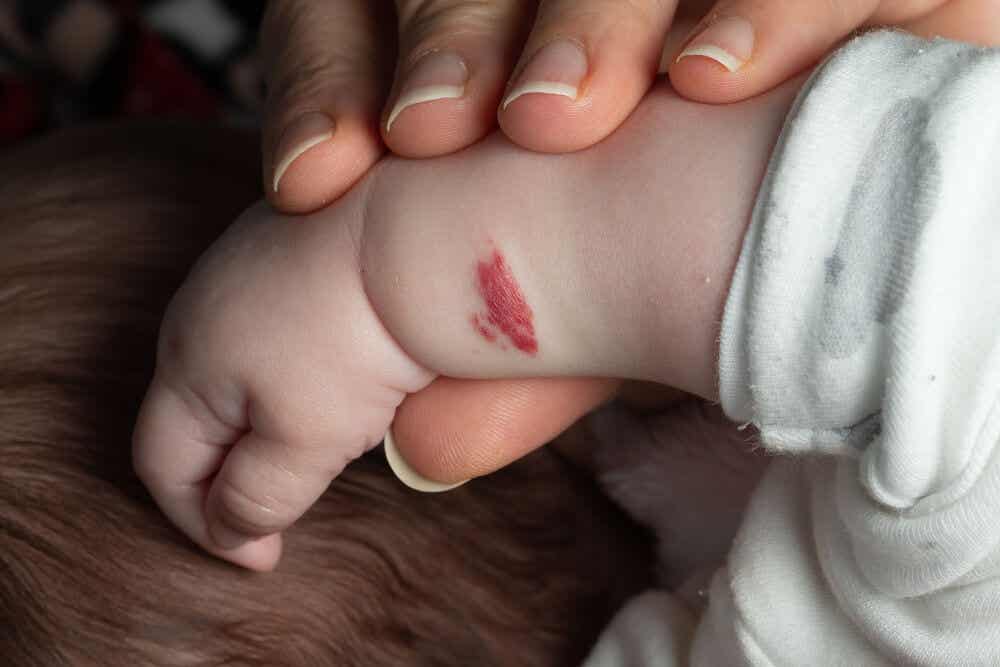Bebé con un angioma en el brazo.
