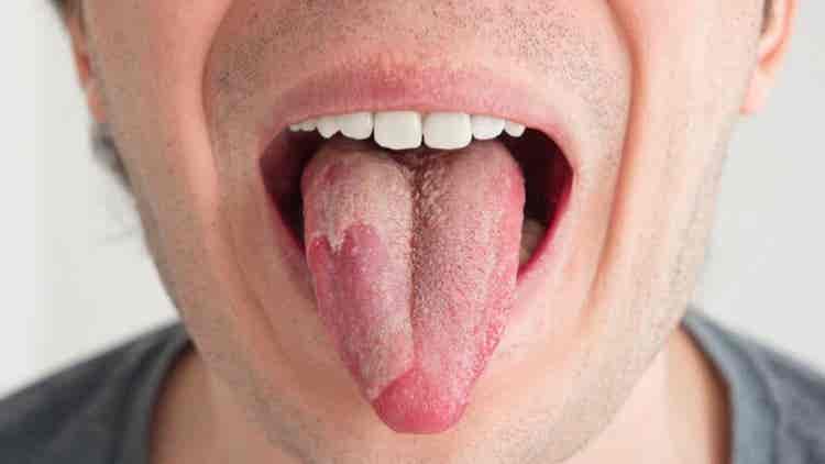Hongos En La Boca S ntomas Causas Y Tratamiento Mejor Con Salud hongos-en-la-boca-s-ntomas-causas-y-tratamiento-mejor-con-salud
