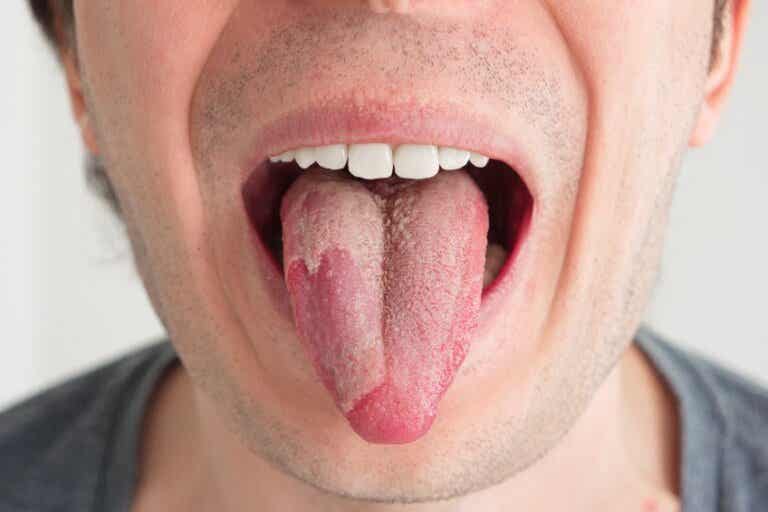 Hongos en la boca: síntomas, causas y tratamiento