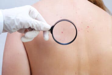 Angioma: qué es, cuáles son sus síntomas y cómo se trata