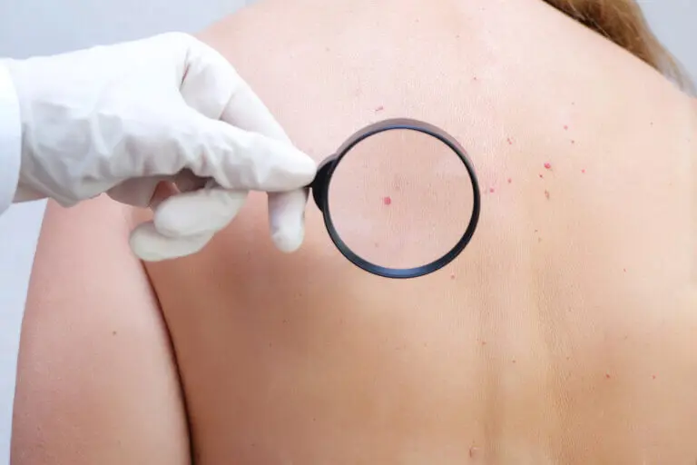 Angioma: qué es, cuáles son sus síntomas y cómo se trata