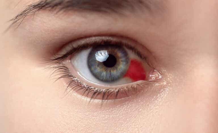 ¿Qué causa un derrame ocular y cómo tratarlo?