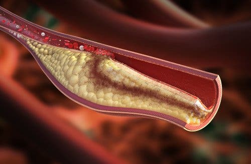 Treat Arteriosclerosis