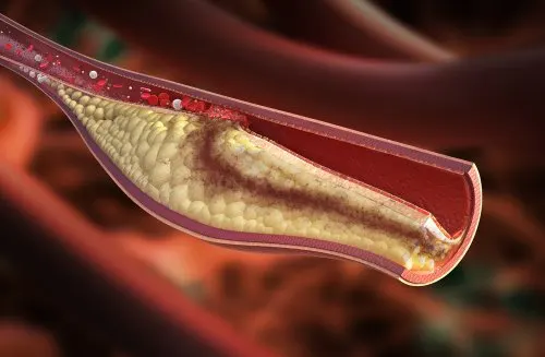 Treat Arteriosclerosis