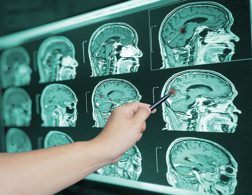 Edema cerebral: causas, síntomas y diagnóstico