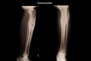 ¿Qué es la osteomielitis?
