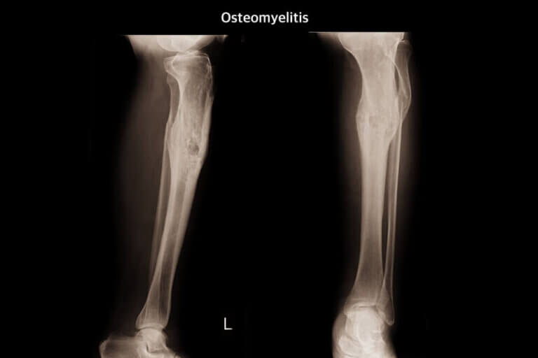 ¿Qué es la osteomielitis?