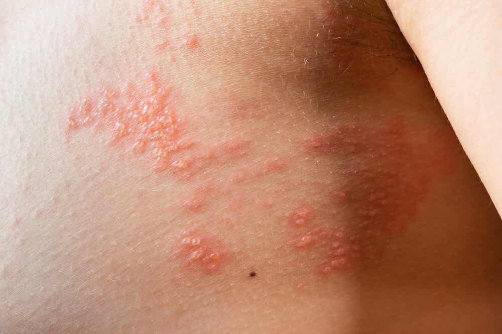 Infección de varicela en adultos