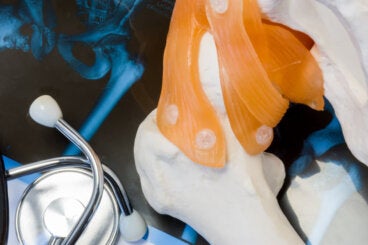 Todo sobre la luxación de cadera