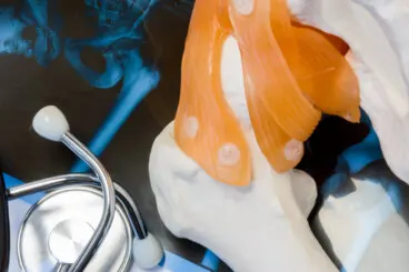 Todo sobre la luxación de cadera