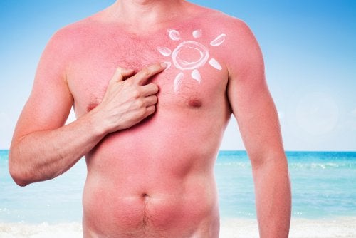 Torso de hombre quemado con crema en forma de sol.