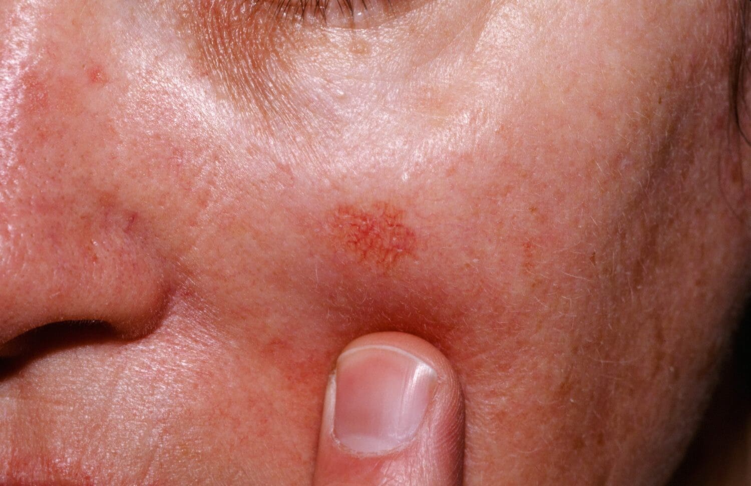 Queratosis actínica