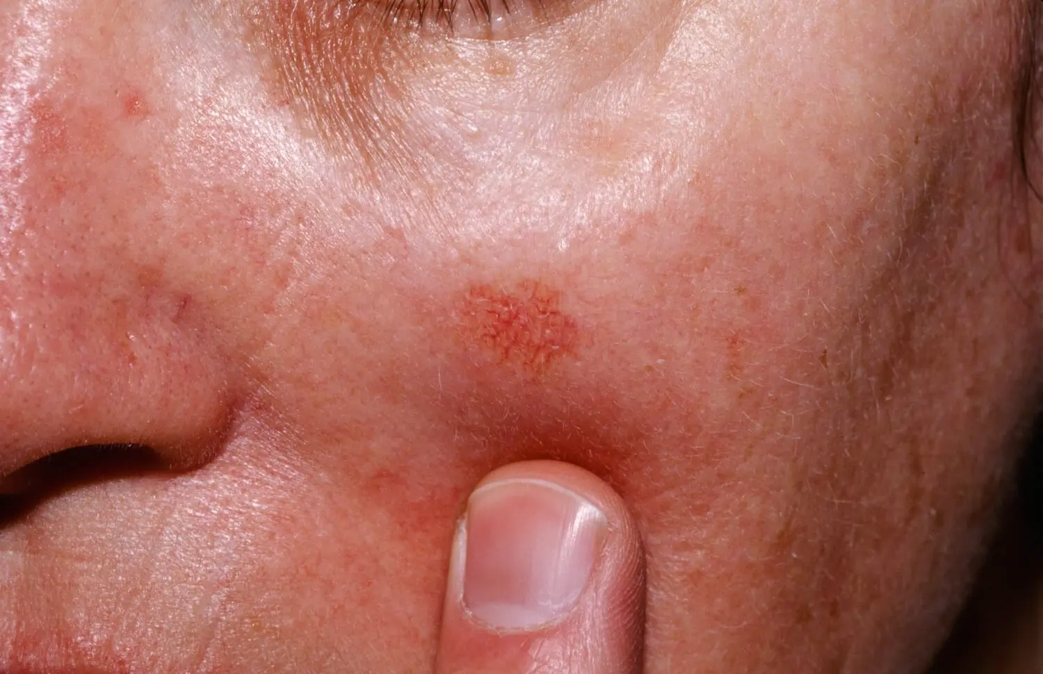 Queratosis actínica