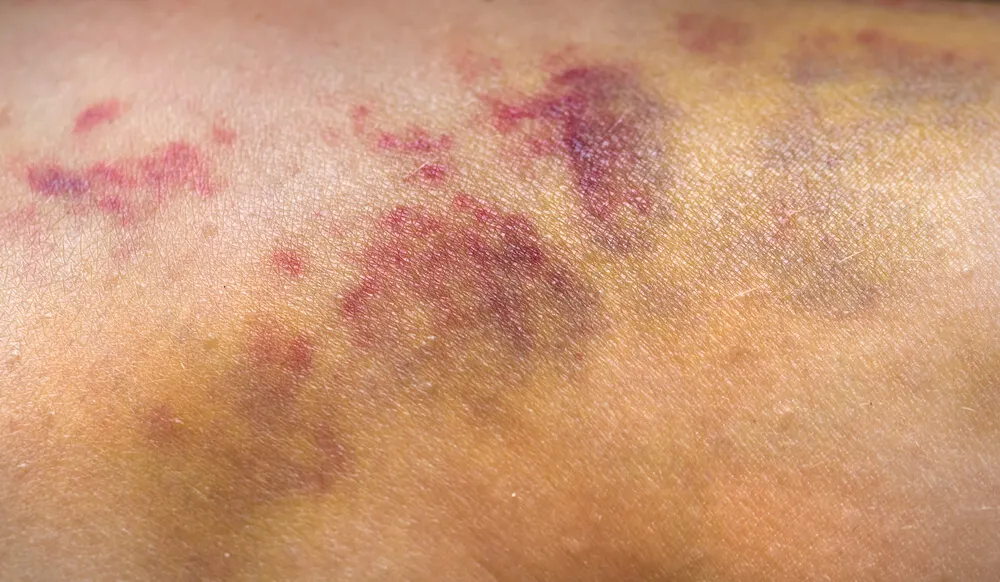 Las manchas rojas en la piel incluyen los hematomas
