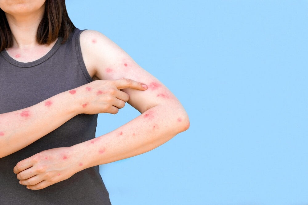 ¿La varicela se contagia también en los adultos?