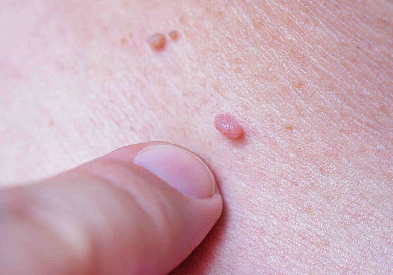 Maneras de detectar el virus del papiloma humano en hombres