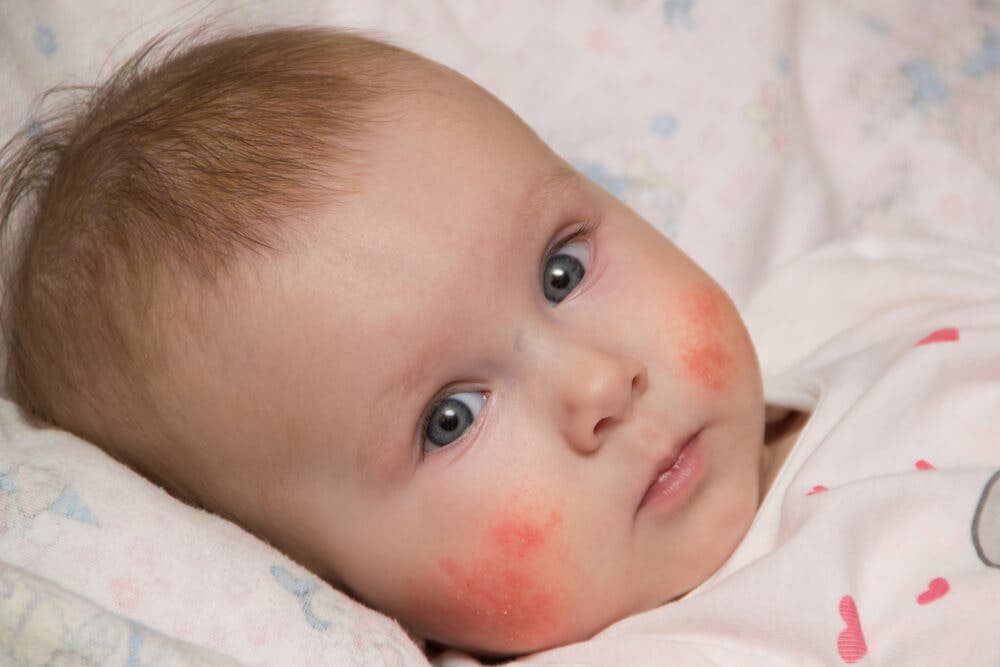 dermatitis perioral