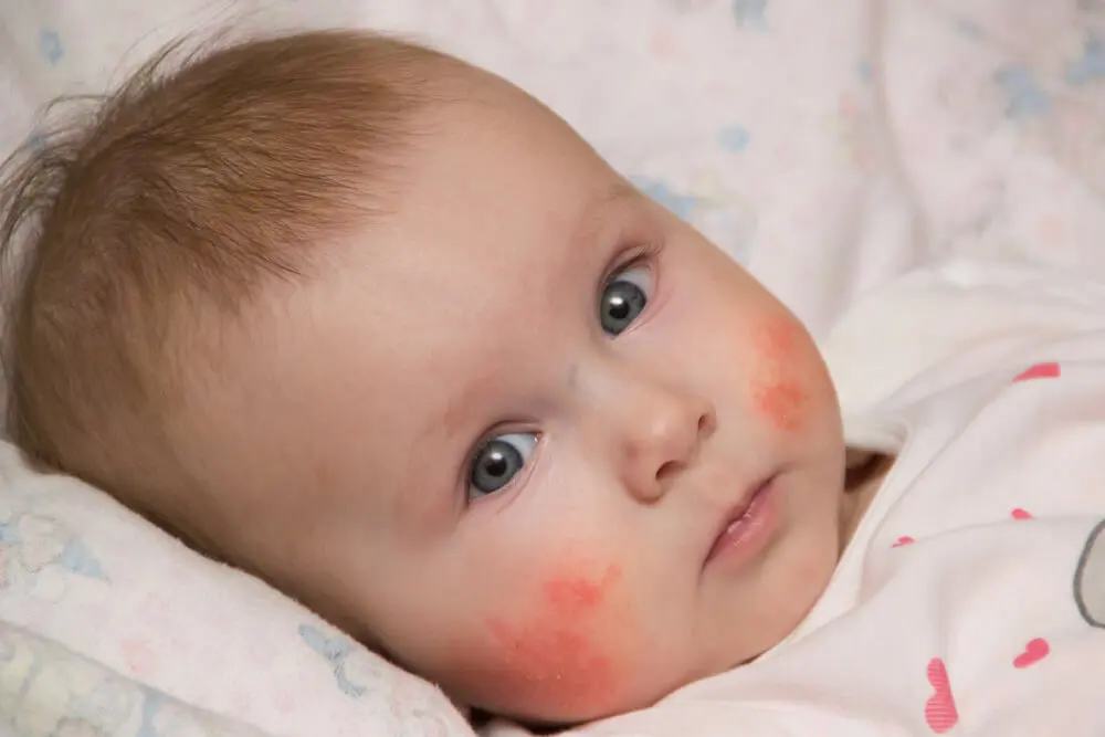 dermatitis perioral