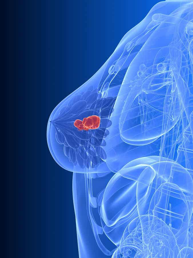 Tipos de terapia hormonal para el cáncer de mama