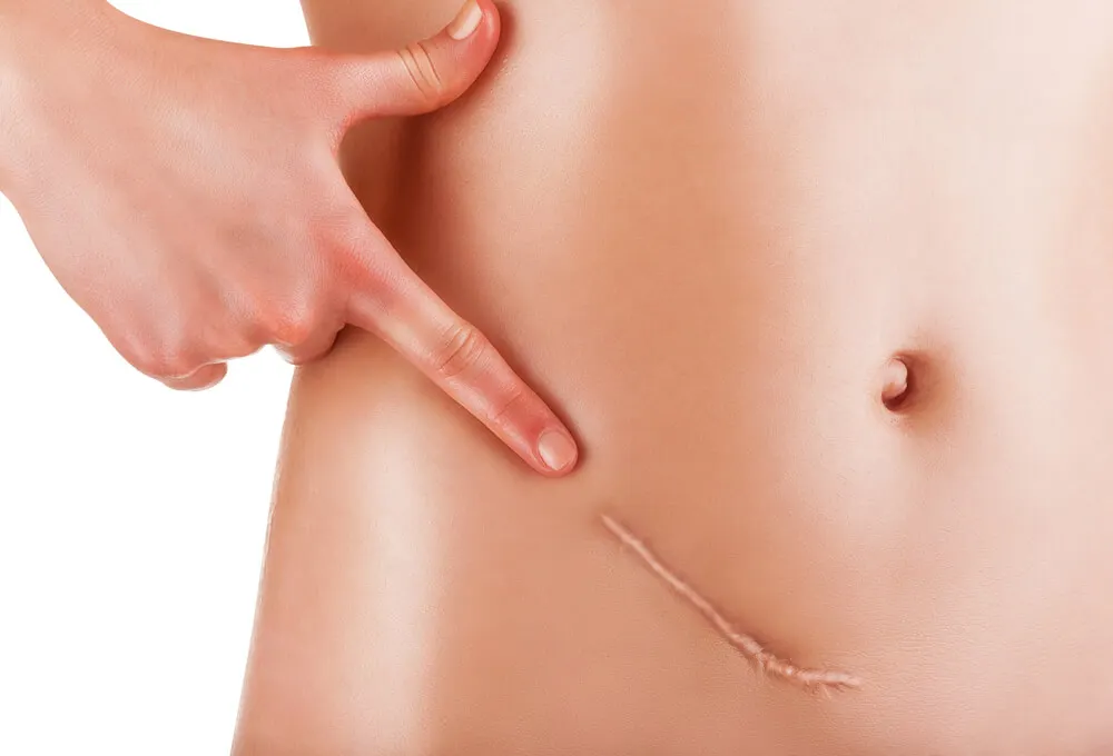 Appendizitis - eine Operationsnarbe