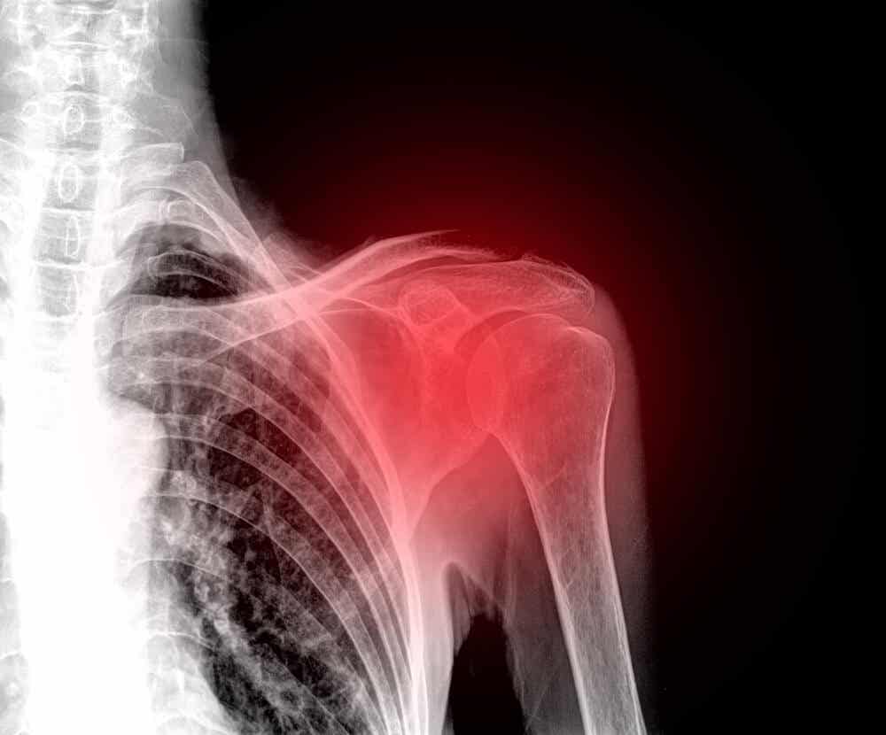 Et røntgenbilde av skuldersmerter