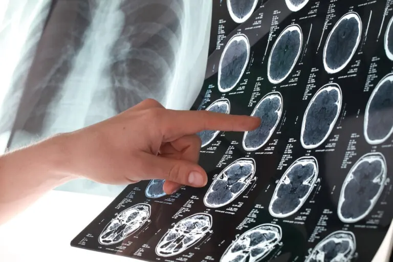 Cómo prevenir un accidente cerebrovascular siguiendo 6 consejos