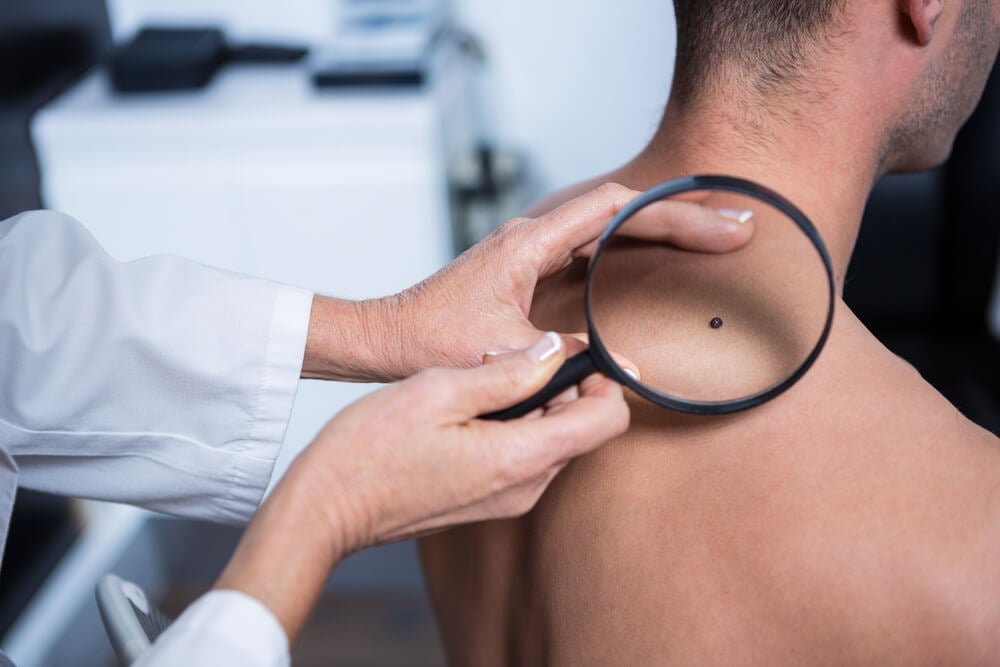 ¿Cómo se produce el cáncer de piel?