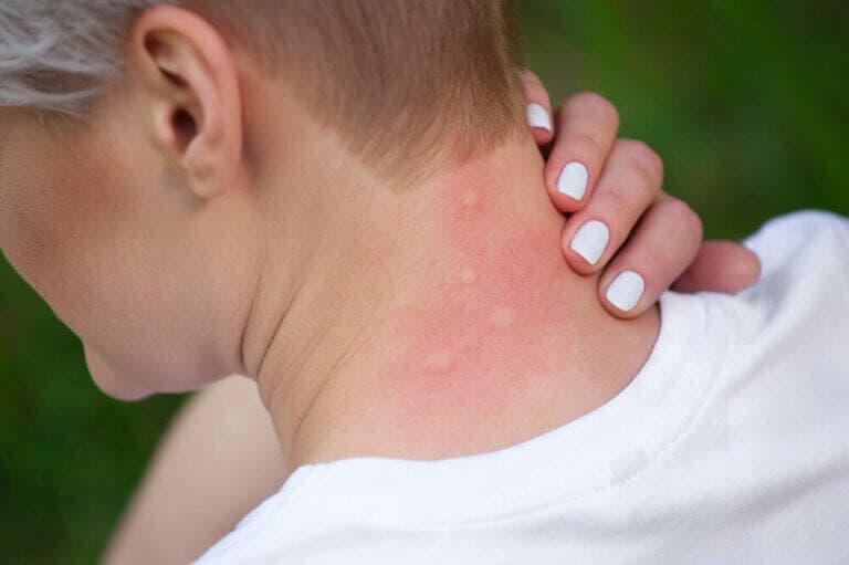 5 remedios para calmar las alergias por picaduras