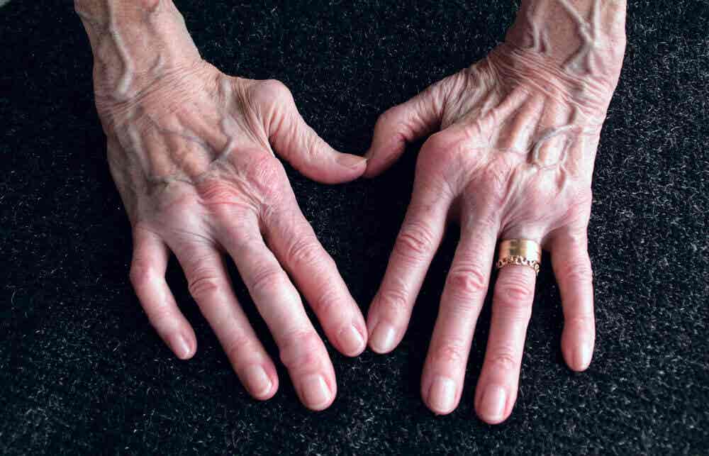Quercetina para la artritis reumatoidea.