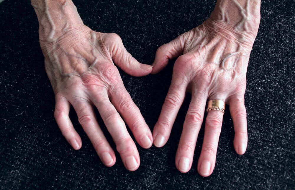 El ñame silvestre y la artritis reumatoide.