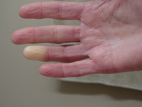 ¿Qué es la esclerodermia?