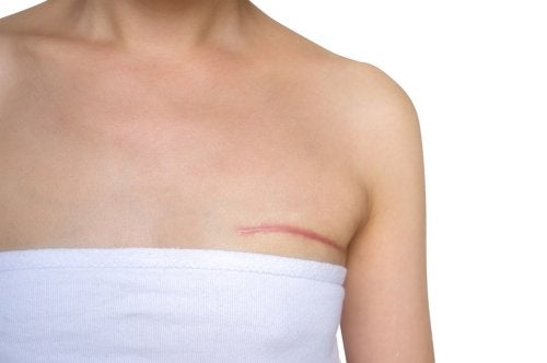 ¿Es bueno hacer una mastectomía preventiva para adelantarse al cáncer de mama?