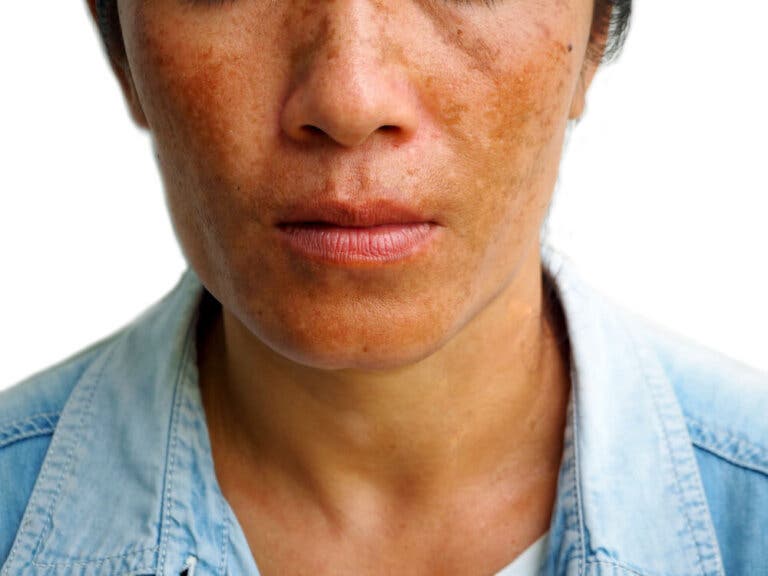 3 tratamientos para reducir las manchas por melasma
