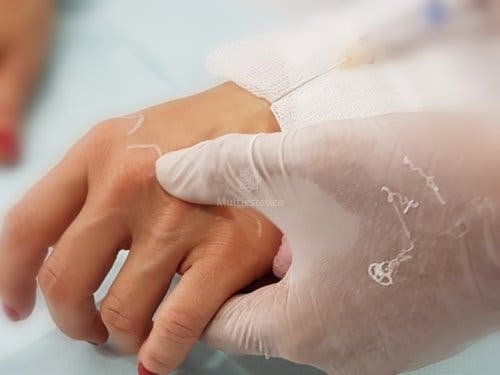 mesoterapia de manos