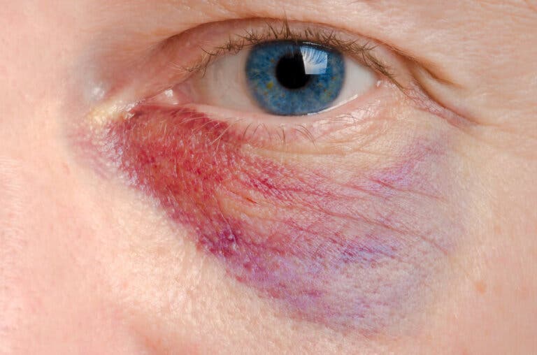 Cómo aliviar un ojo morado: 6 tratamientos naturales